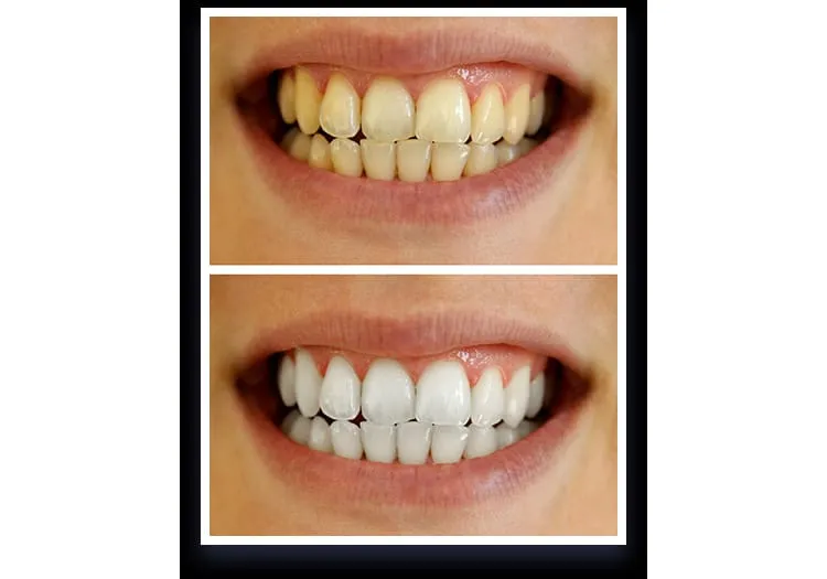 28140 teeth whitening product review