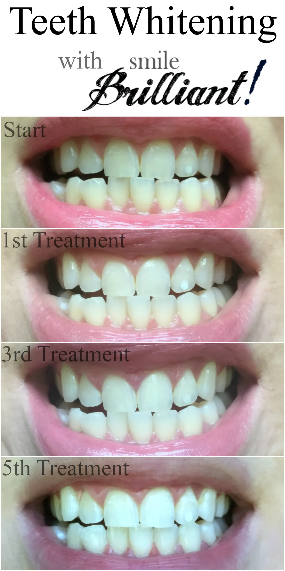28140 teeth whitening secret 1