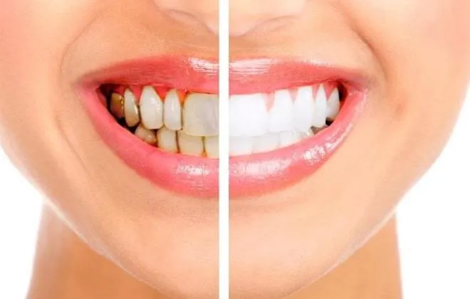 28143 tooth whitening atlanta image3
