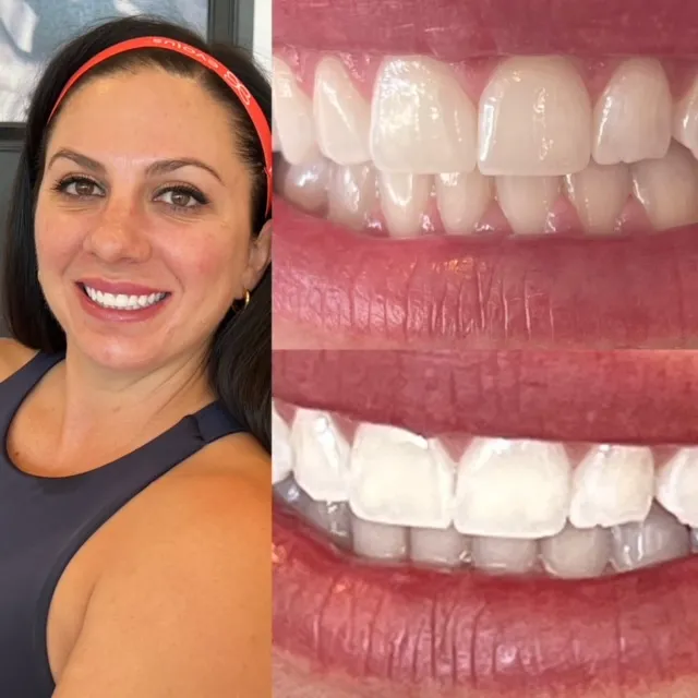 28150 baton rouge teeth whitening image5