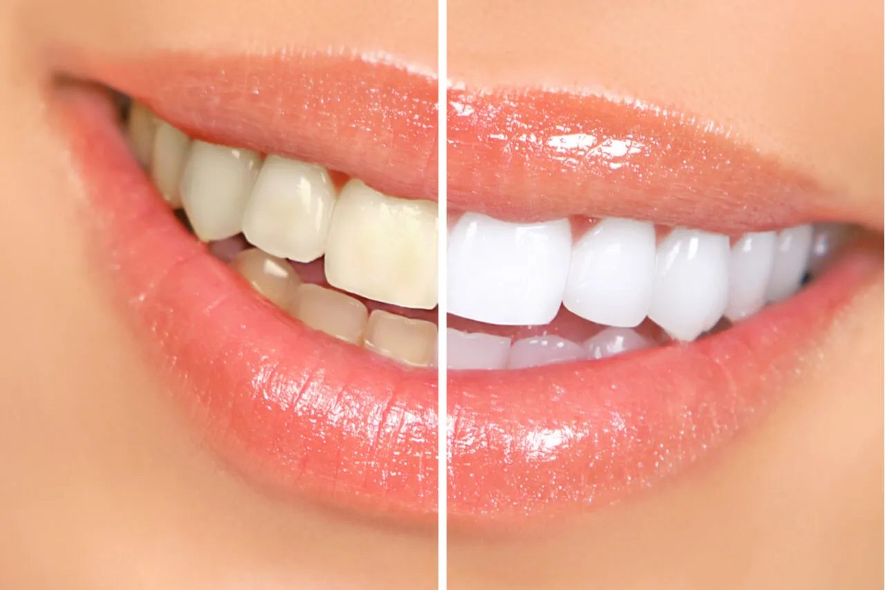 28151 teeth whitening cost