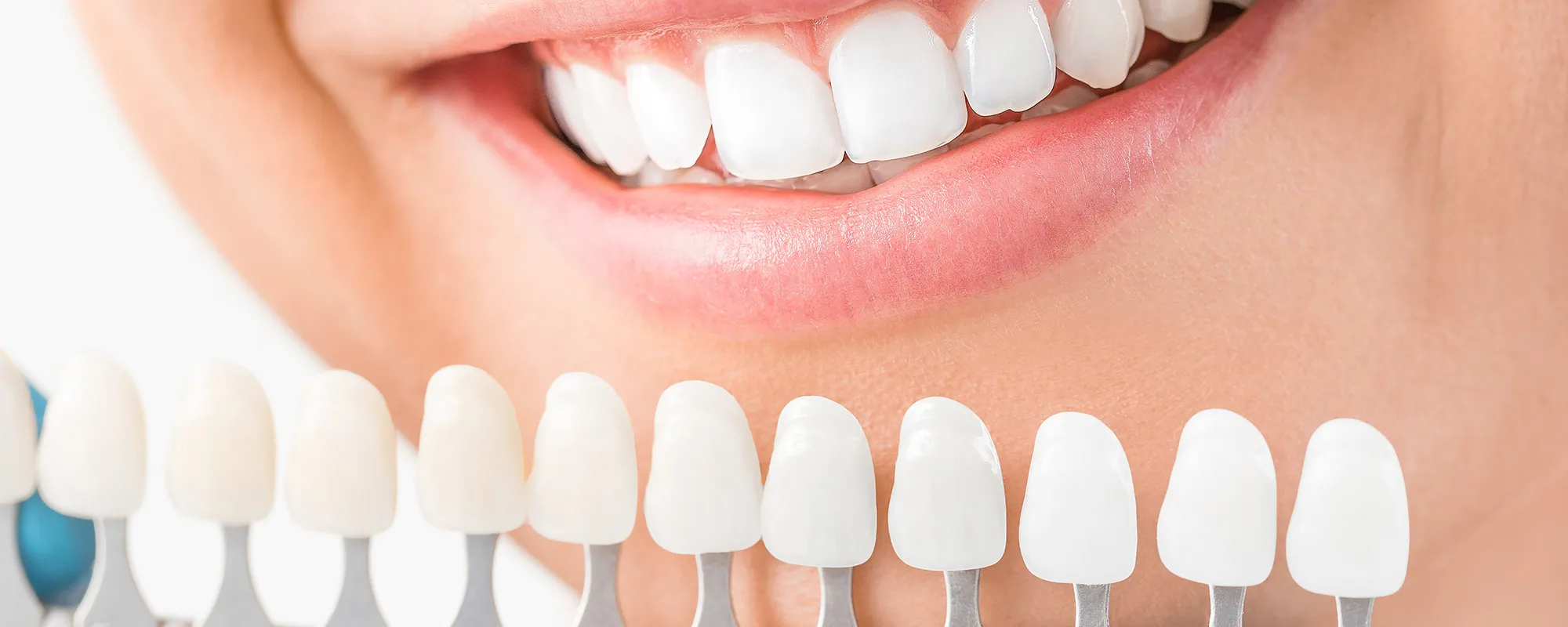 28153 teeth whitening cincinnati oh image3