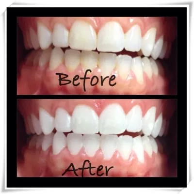 /img/28153-teeth-whitening-cincinnati-oh-image7.webp