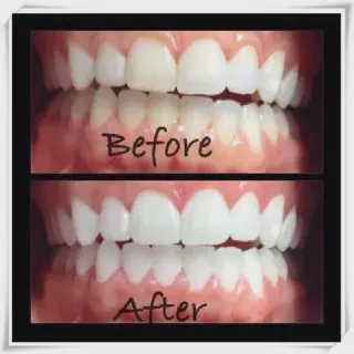 /img/28153-teeth-whitening-cincinnati-oh-image7.webp