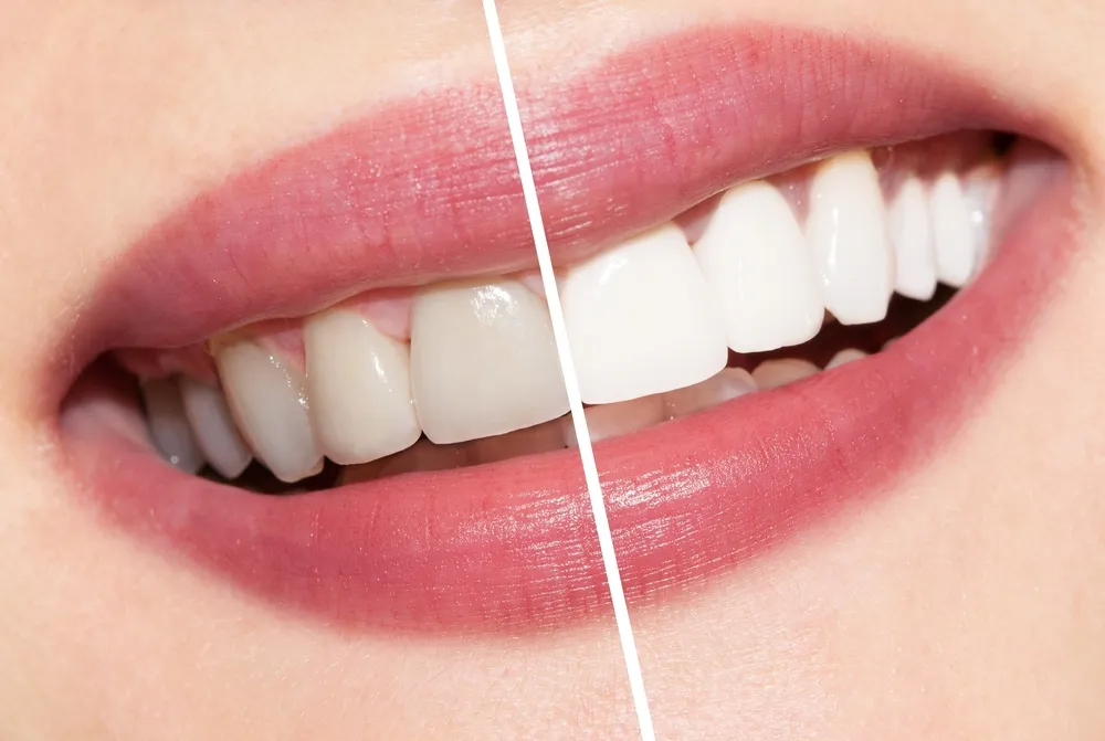28164 teeth whitening tips