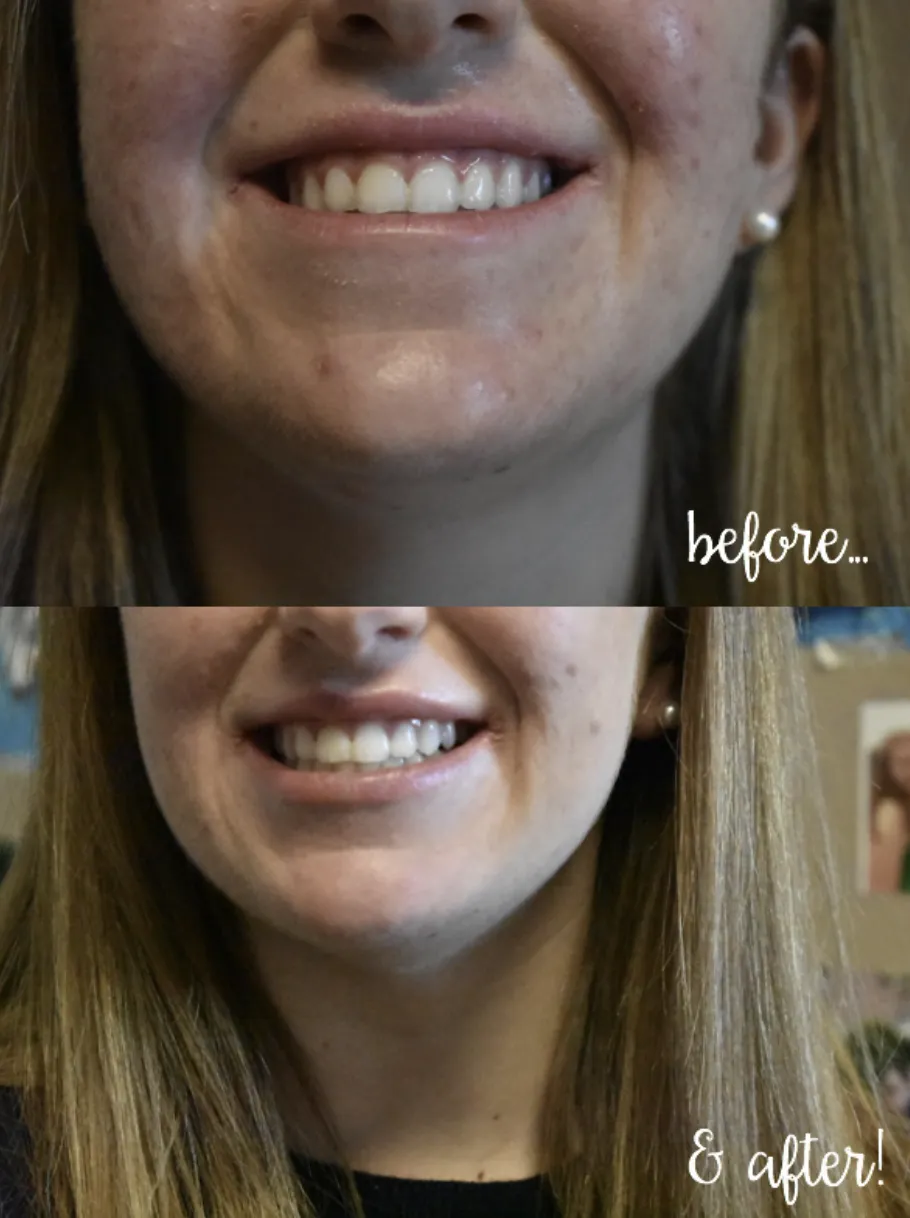 28167 chic delta teeth whitening testimonials