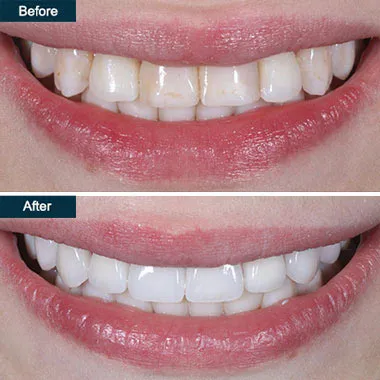 28172 professional teeth whitening