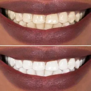 28179 professional teeth whitening