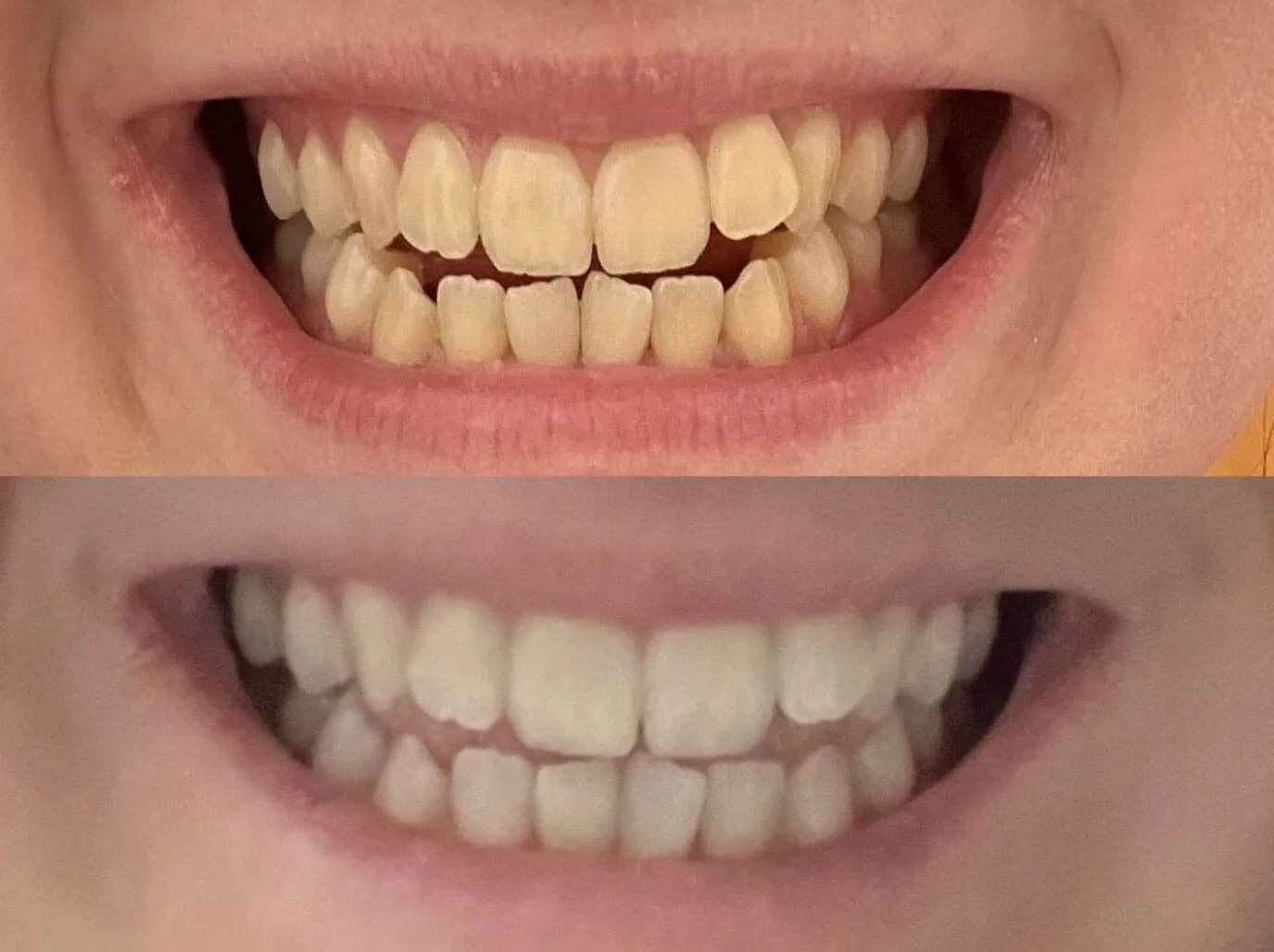 28182 diamond dust teeth whitening enamel health