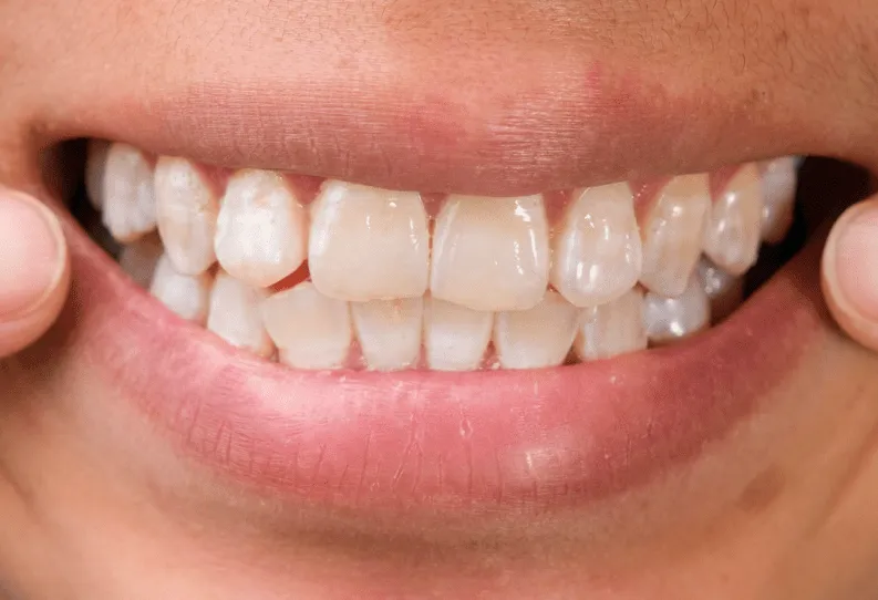 /img/28190-white-spots-teeth-7.webp