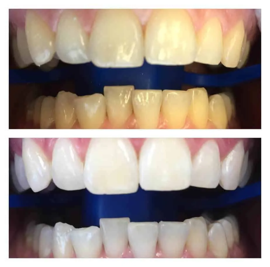 28193 teeth whitening kissimmee avoid stains