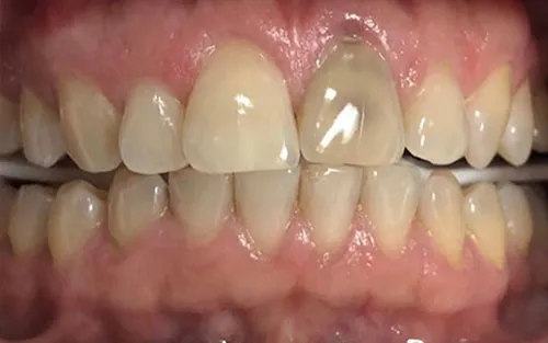 28193 teeth whitening kissimmee dentist consultation