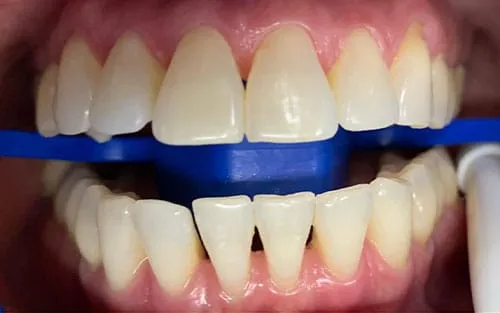 28193 teeth whitening old town kissimmee options