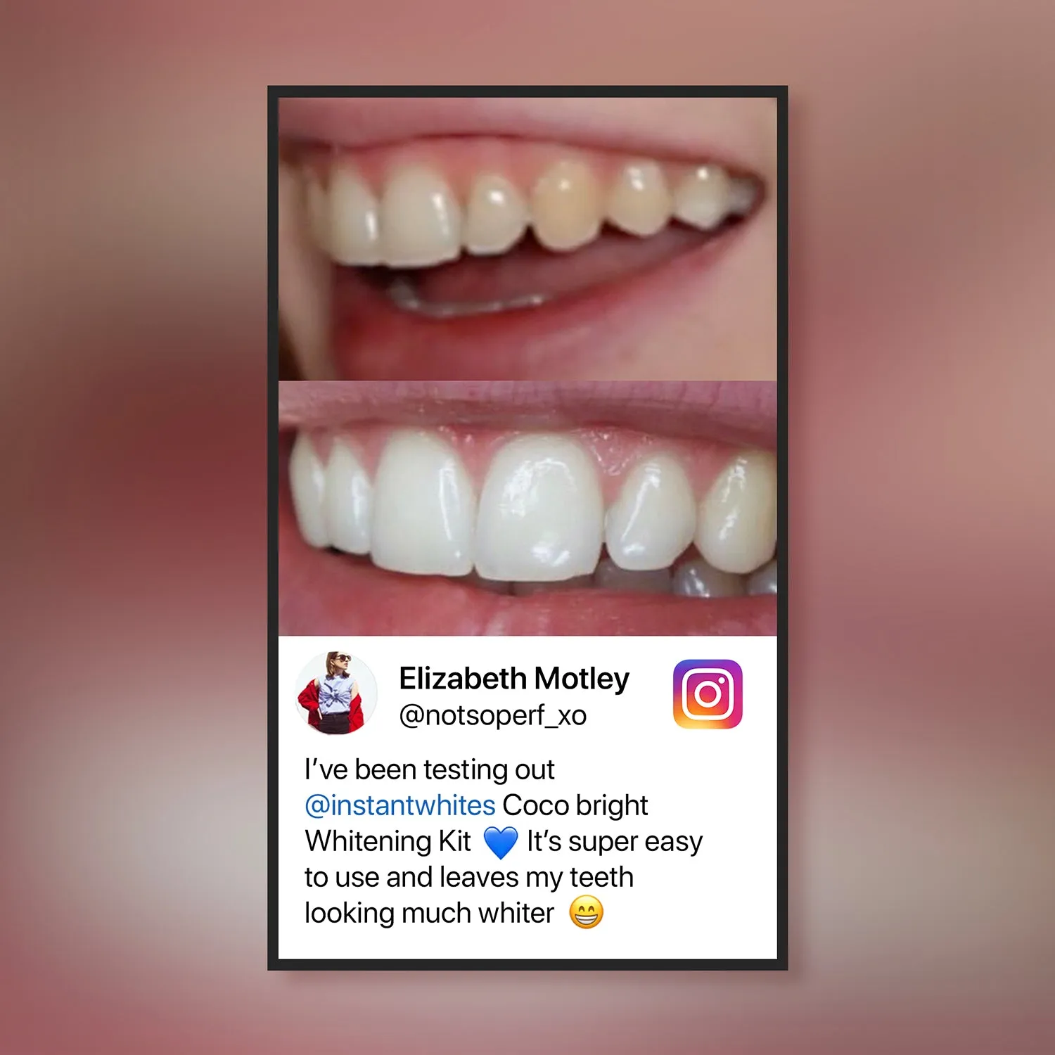 28198 teeth whitening results