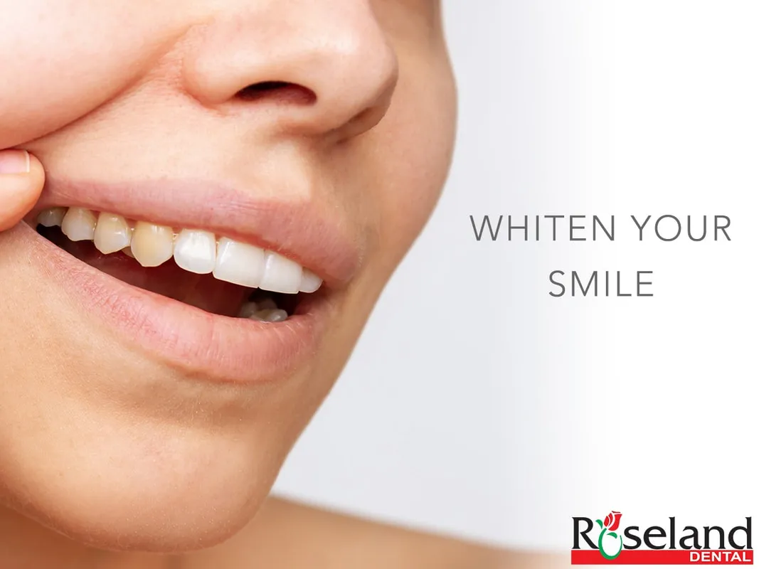 28206 over the counter whitening