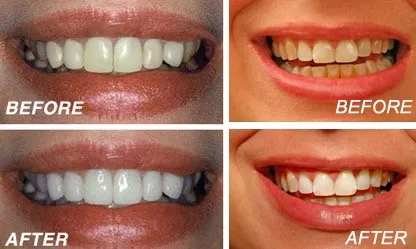28207 peroxide teeth whitening process