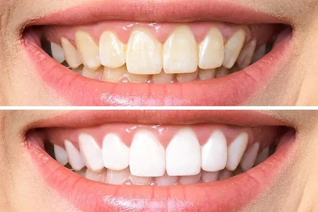 28207 professional teeth whitening