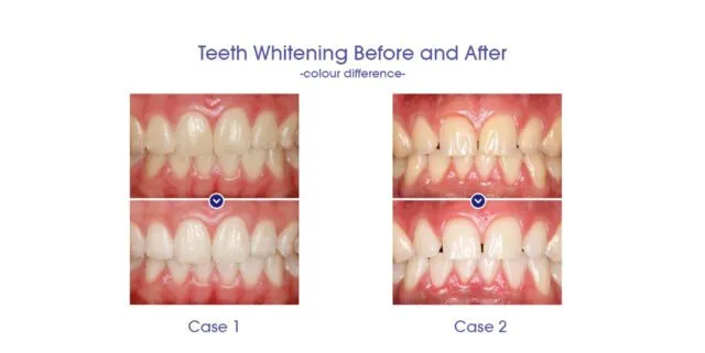 28207 teeth sensitivity management