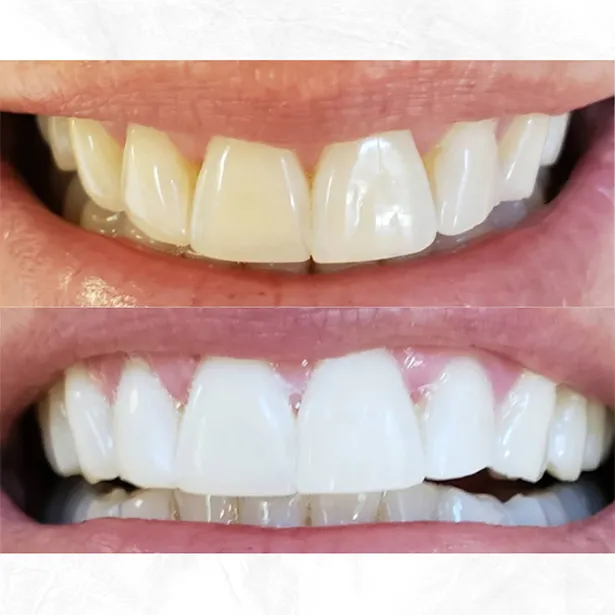 28207 teeth staining causes