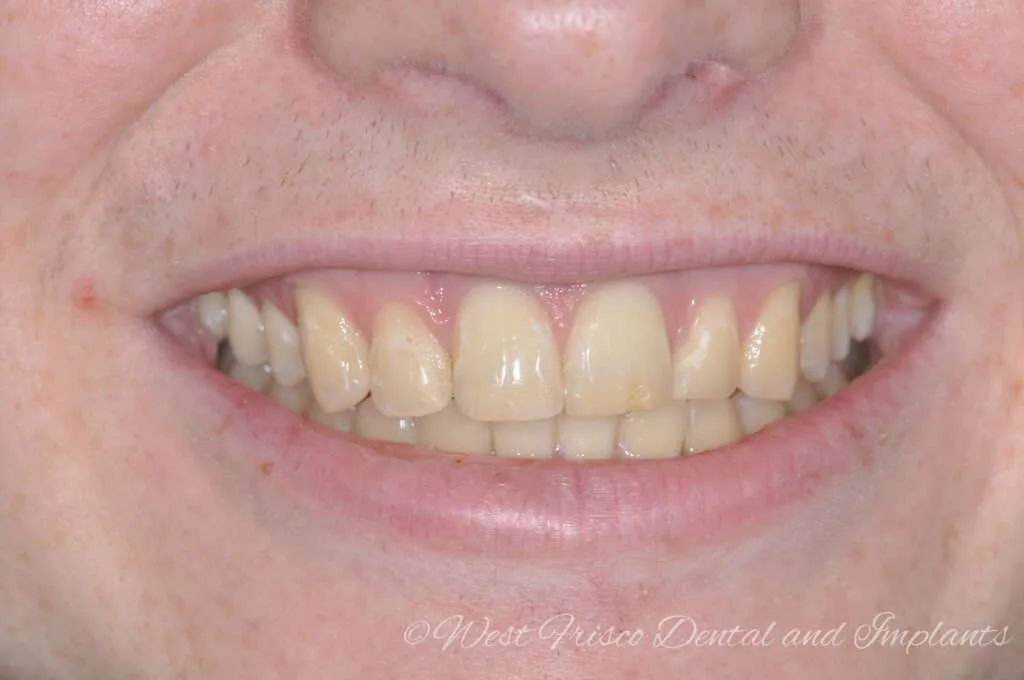 28226 zoom teeth whitening image5