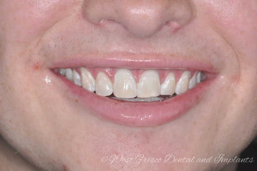 28226 zoom teeth whitening image6