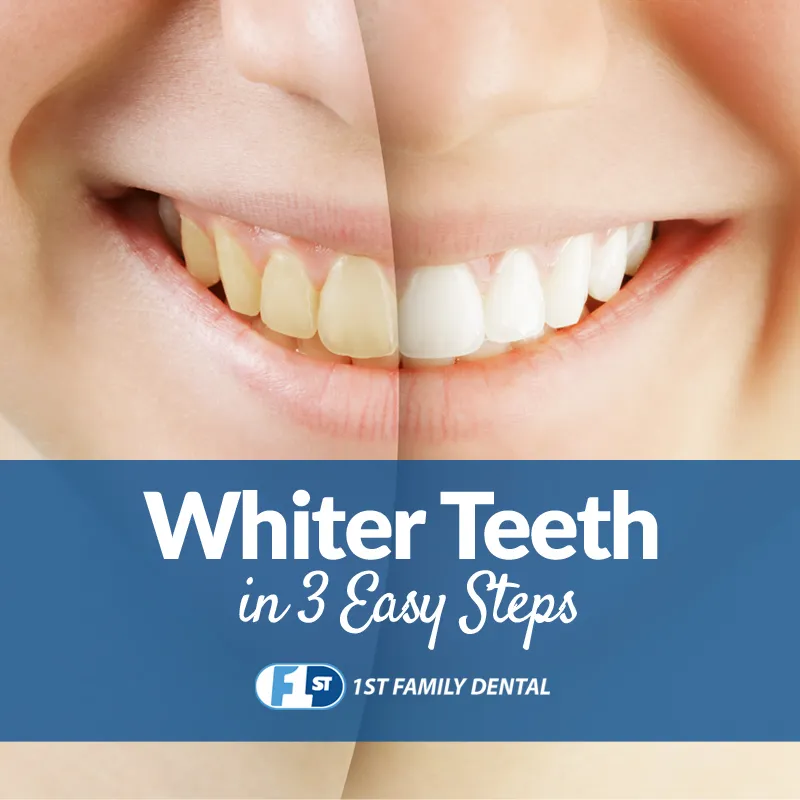 /img/28226-zoom-teeth-whitening-image7.webp