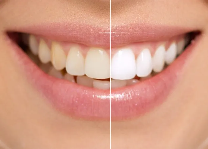 28228 sensitive teeth whitening 1