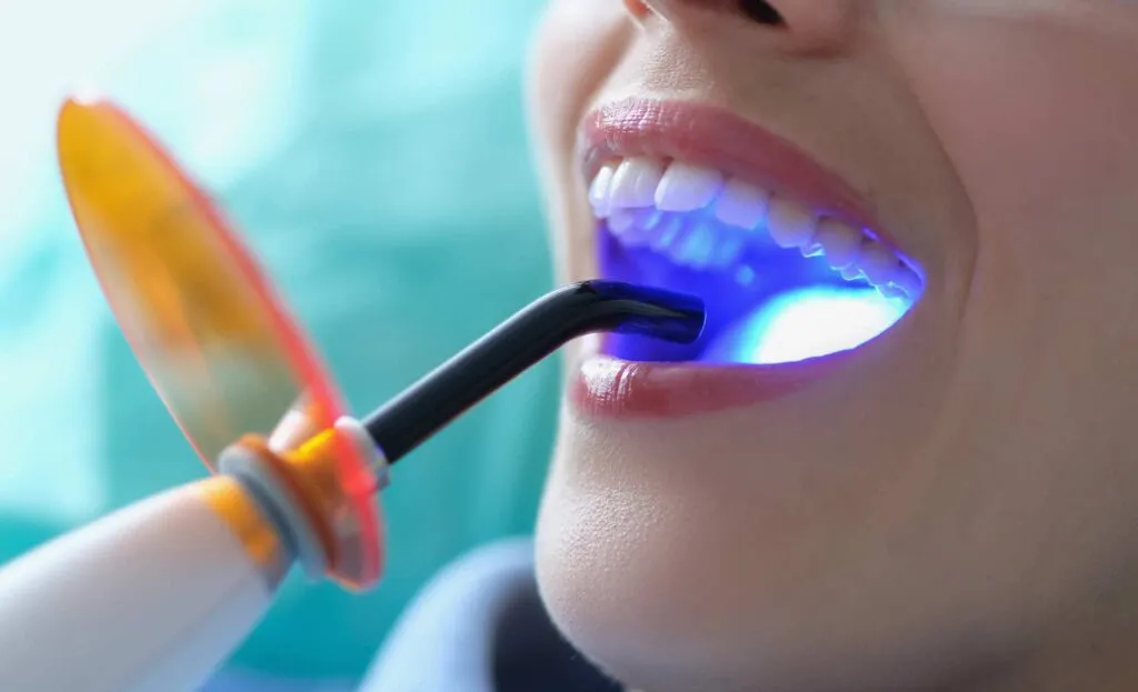 28231 in office teeth whitening