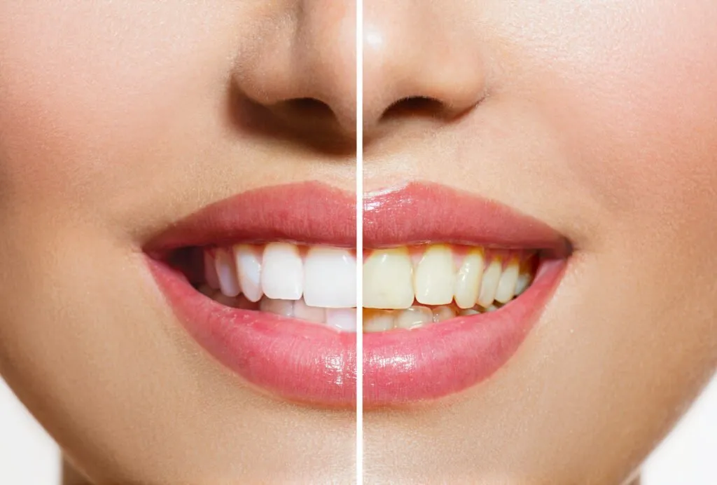 28236 professional teeth whitening