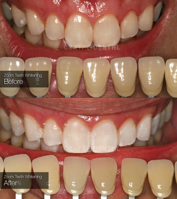 28237 zoom whitening gel