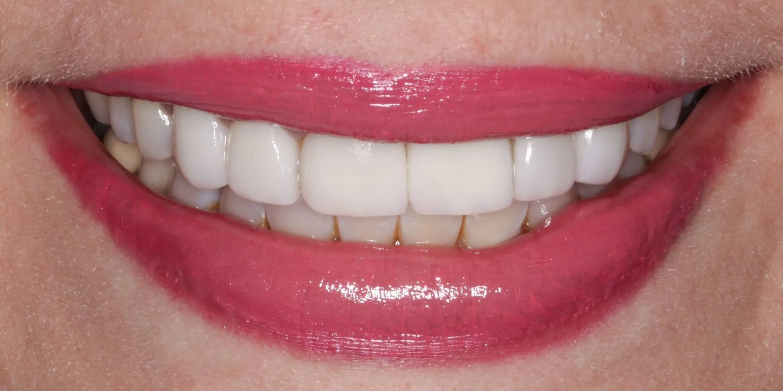 28238 in office teeth whitening