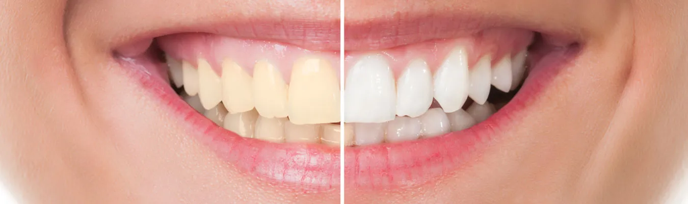 28238 teeth whitening food drinks