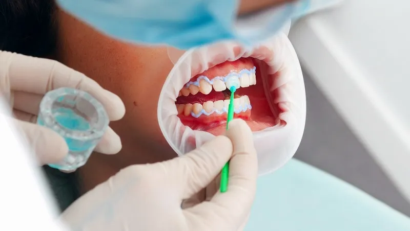 28240 sensitive teeth