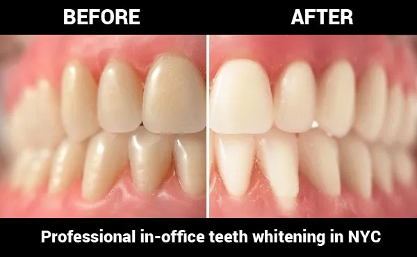 28252 teeth whitening insurance