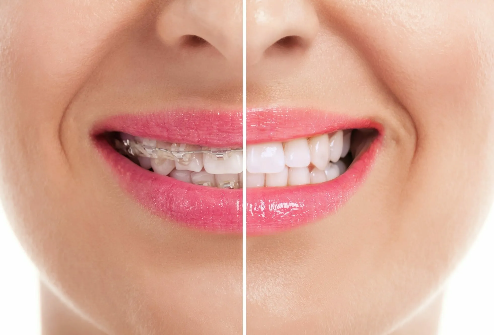 28254 whitening strip application
