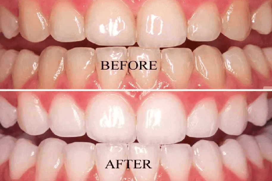 /img/28260-whitening-strips-comparison.webp