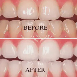 /img/28260-whitening-strips-comparison.webp