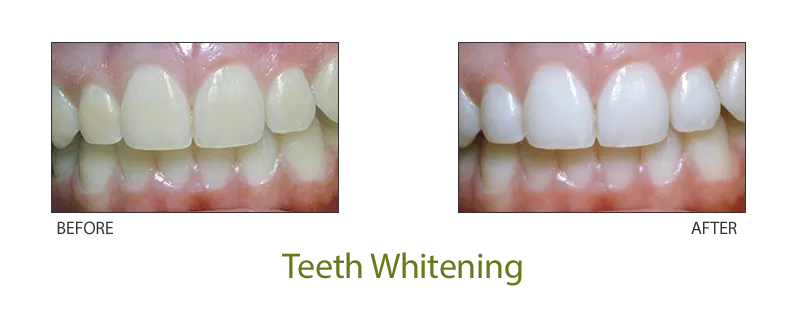 28262 in office teeth whitening