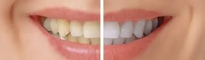 28263 over the counter whitening
