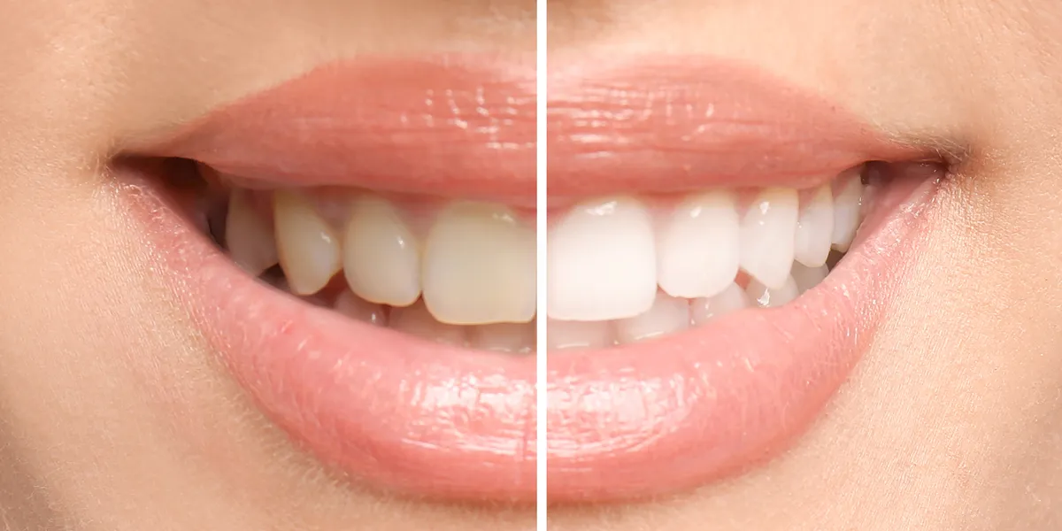 28264 in office teeth whitening