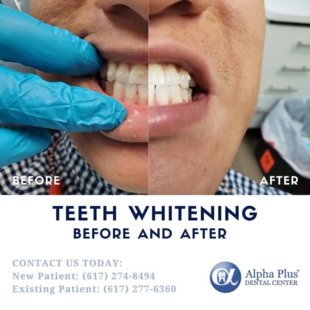 28264 teeth whitening results