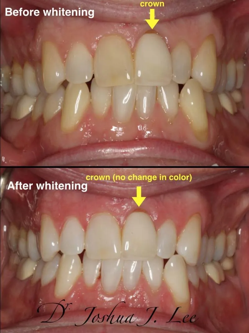 28265 zoom whitening manhattan dentist