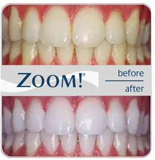 28265 zoom whitening manhattan smile confidence