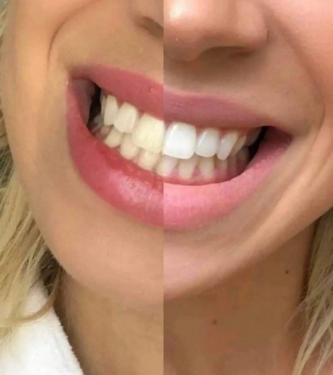 28270 professional teeth whitening