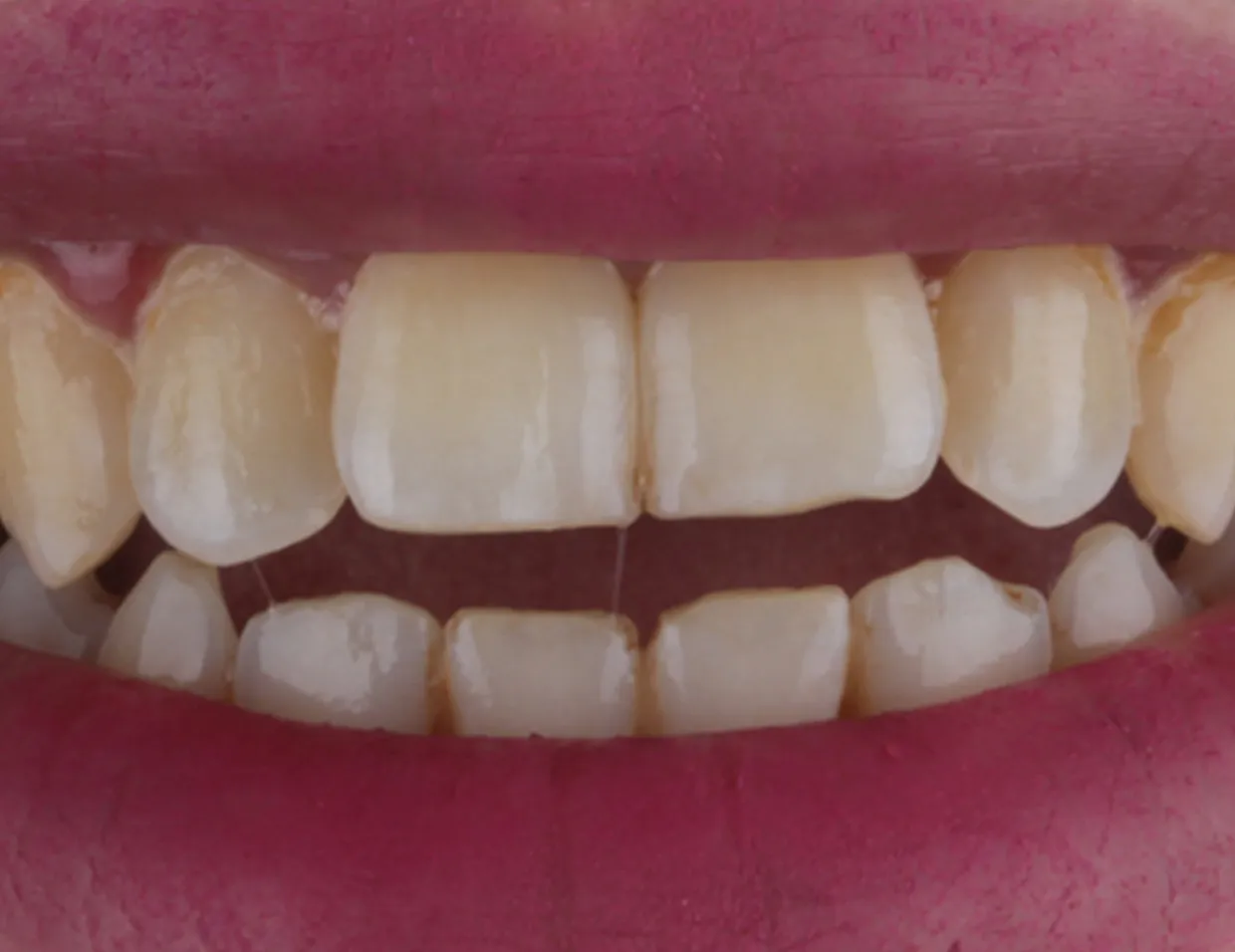 /img/28273-teeth-whitening-cost.webp