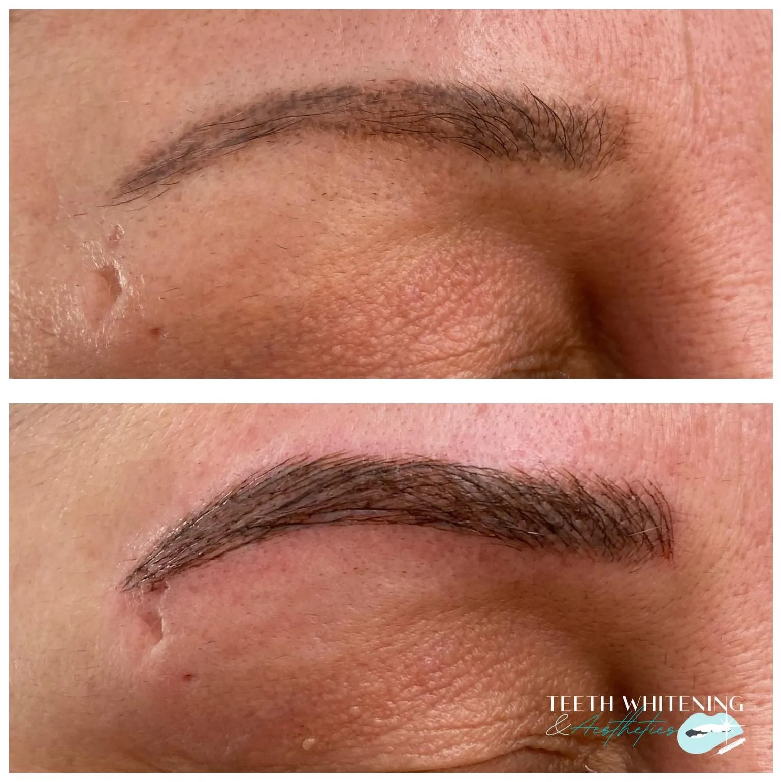 28278 at home teeth whitening kits