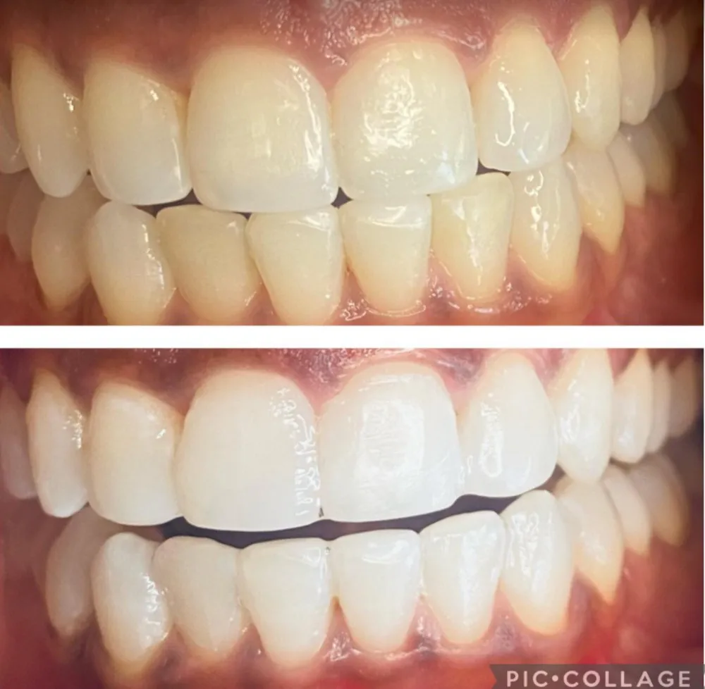 28278 in office teeth whitening