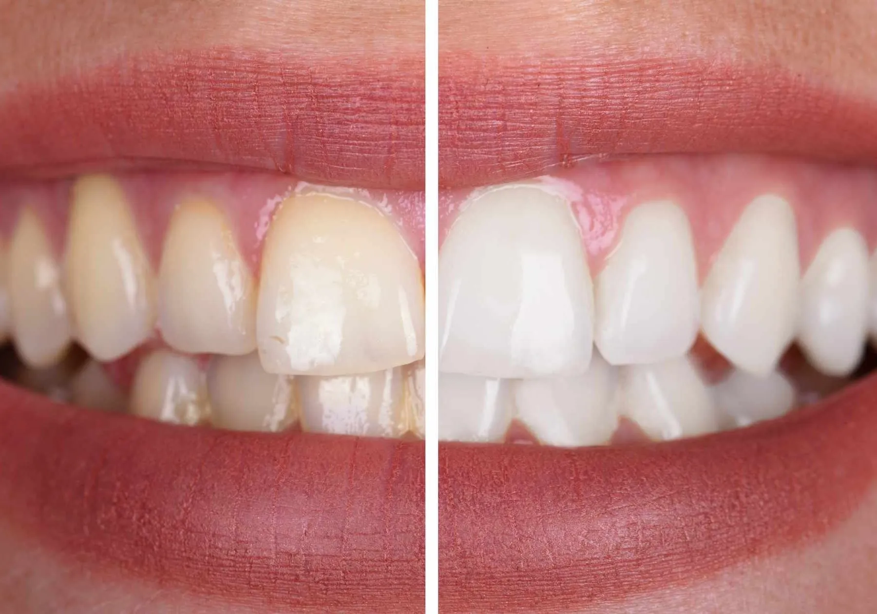 28294 brushing technique