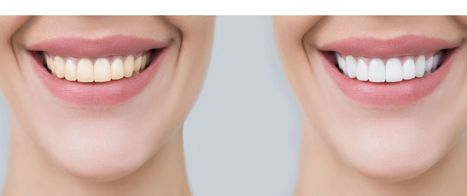 28303 teeth whitening aftercare