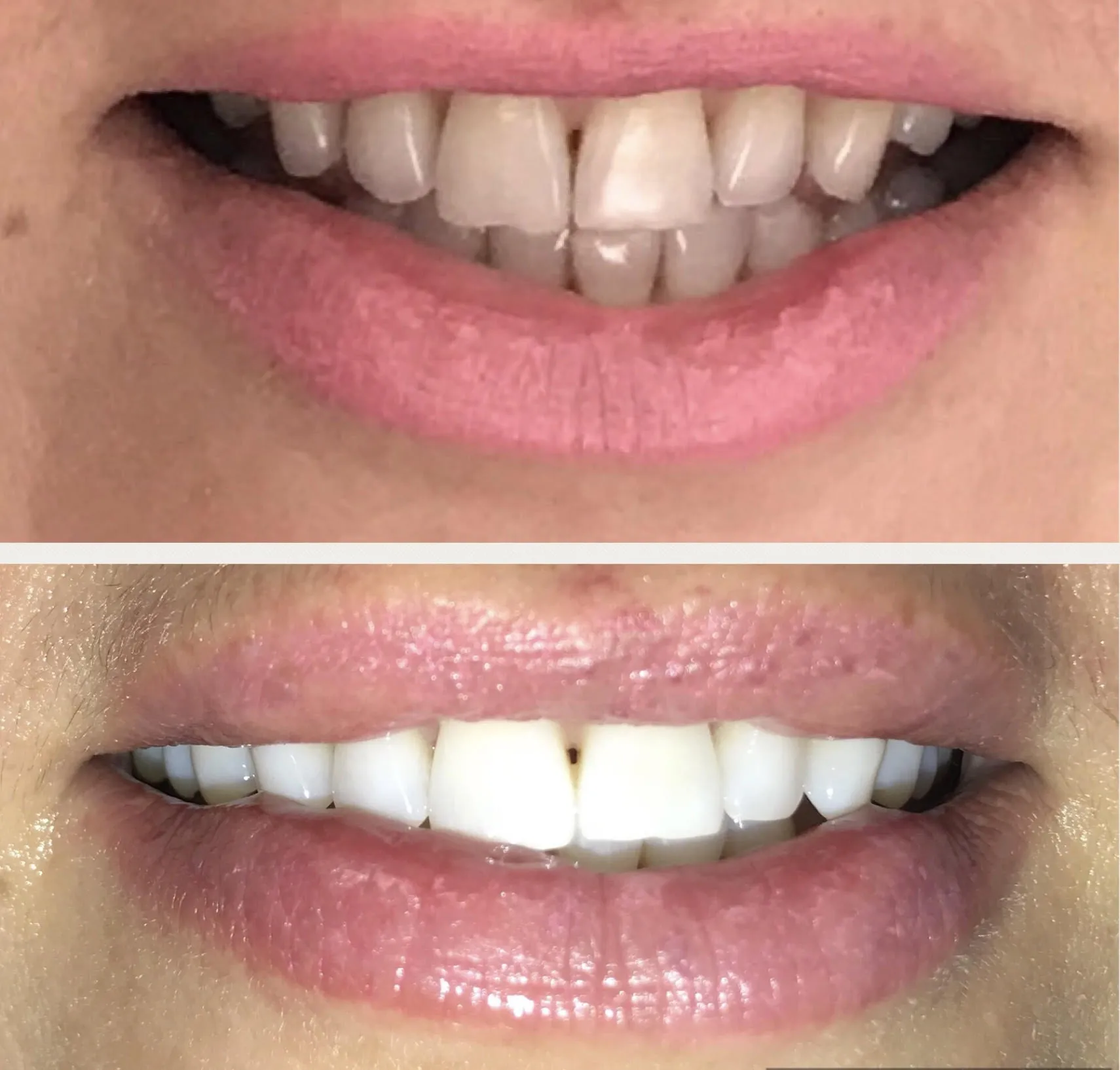 28303 teeth whitening cost